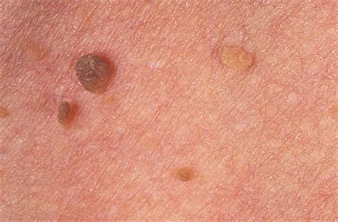 Pictures Of Skin Tags Cysts Lumps And Bumps And When