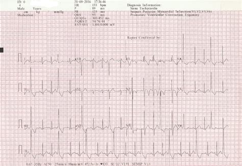 An Ecg Showing Sinus Rhythm With Ventricular Trigeminy Normal Axis