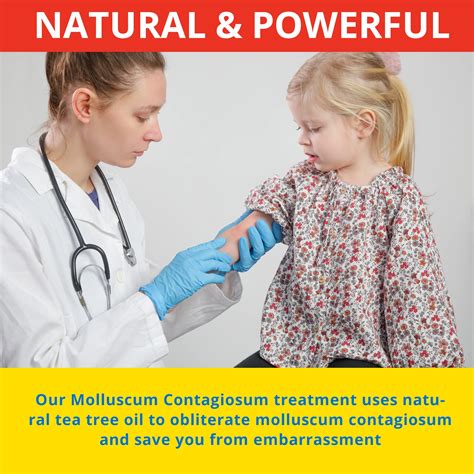 Buy Molluscum Contagiosum Treatment Fast Safe Painless All Natural