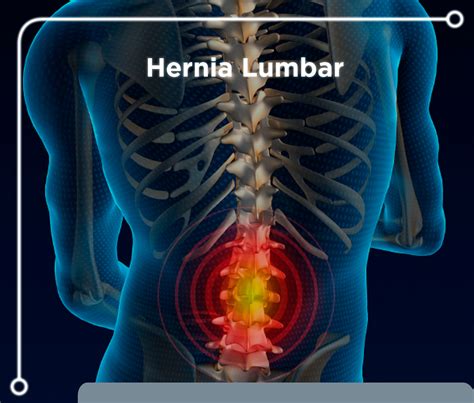 Hernia Discal Lumbar Osteopatía Atlas