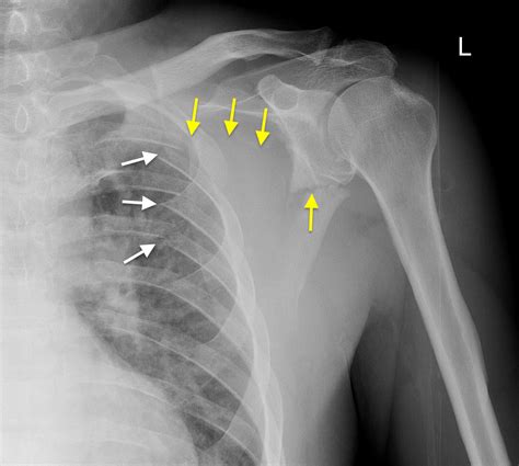 Scapular Bone Anatomy