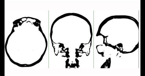 Ct Scan ของสมองแกน Coronal และ Sagittal ดูโหมดขาวดํา ภาพสต็อก ดาวน์