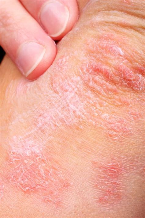 How To Deal With Your Psoriasis Symptoms