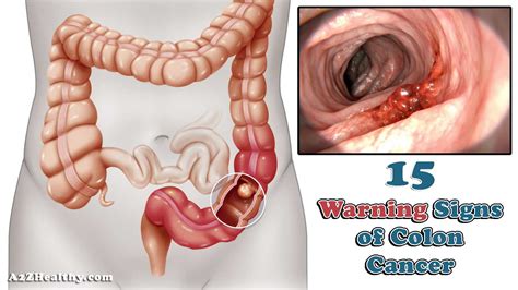 15 Warning Signs Of Colon Cancer You Should Not Ignore
