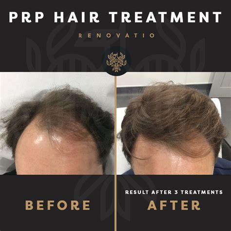 Prp Hair Loss Treatment Manchester Renovatio Clinic Cheshire