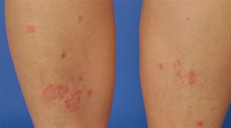 Scaly Erythematous Plaques Occurring On The Lower Extremity Months