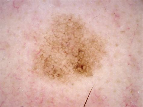 Early Detection Of Melanoma And Assessment Of Asymptomatic People At