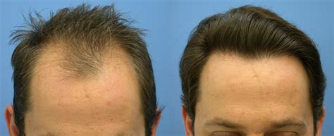 Neograft Curly hair : Cost Effective Treatment For Hair ...
