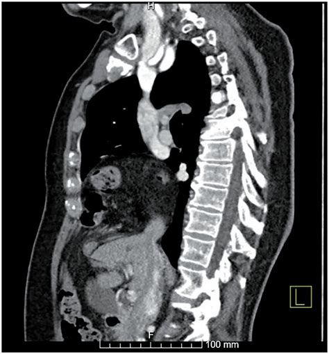 A Sagittal View Of A Morgagni Hernia From A Ct Scan Showing The Defect