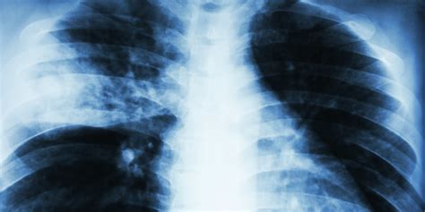 Diagnosis And Treatment Of Community Acquired Pneumonia In Children And