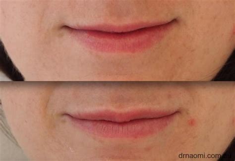 Small Lips Improved With 1ml Dermal Filler Best Clinic Sydney For