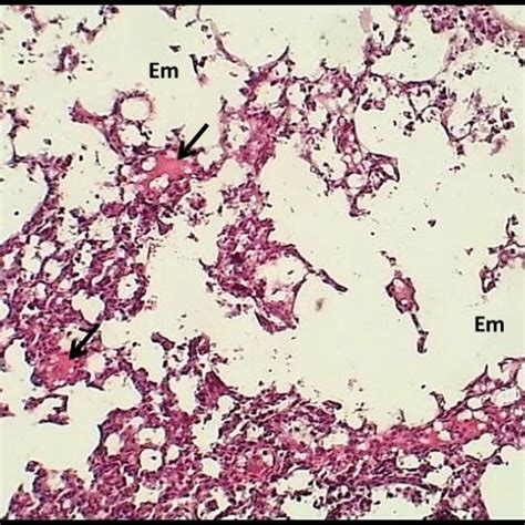 20 Magnified Section Of Hepatic Cords From The Infected Group On The