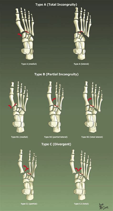 The Myersons Classification Of Lisfranc Injuries 48 From Stavlas Et