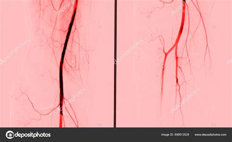 Femoral Angiogram Medical Procedure Used Visualize Blood Vessels Groin