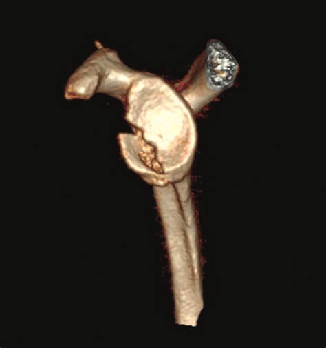 Fracture Involving A Significant Portion Of The Anterior Glenoid Fossa