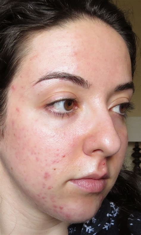 My Skins Journey Week 12 Banish Acne Scars