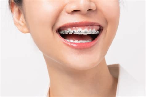How Much Do Braces Cost Braces Price Hornsby Dental
