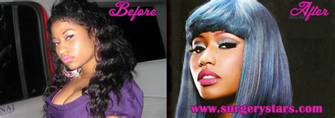 nicki minaj plastic surgery before and after pictures