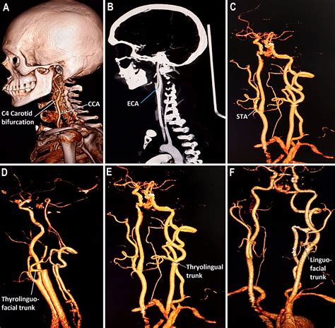 Cureus Morphometric Study And Branching Patterns Of External Carotid