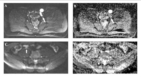 figure 1 from magnetic resonance imaging findings of ovotesticular disorder of sex development