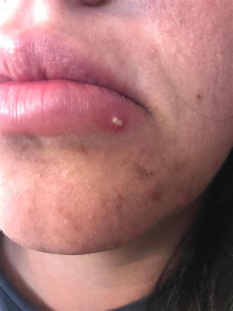 Lip Pimple Swelling