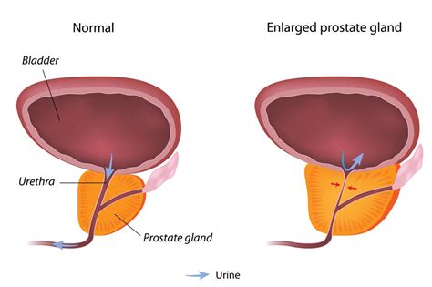 Benigno povećanje prostate Uvjeti 2023