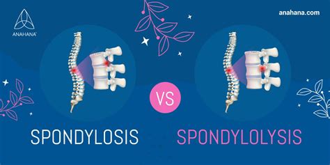 Spondylosis Vs Spondylolysis The Differences And Treatments