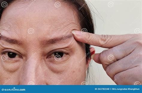 The Flabby Skin And Cellulite Under The Eyes Wrinkles And Ptosis
