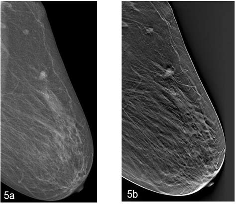 A Dm Mlo View Of The Left Breast Shows A Dense Area Of Architectural