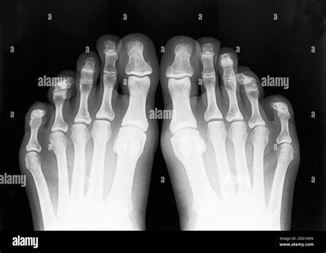 X Ray Image Of Foot Fingers Stock Photo Alamy