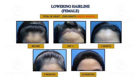 Lowering Hair Line Hair Treatment Klinik Dr Inder Fue Hair Transplant