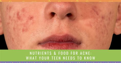 Nutrients And Food For Acne What Your Teen Needs To Know