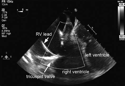 Pacemaker Lead Induced Severe Tricuspid Valve Stenosis Circulation