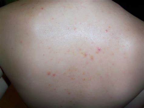 Little Bumps On Back Pictures Photos