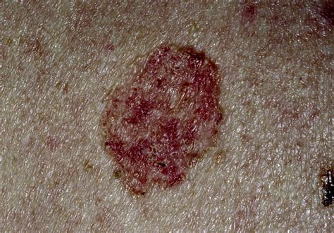 Basal Cell Carcinoma The Bmj