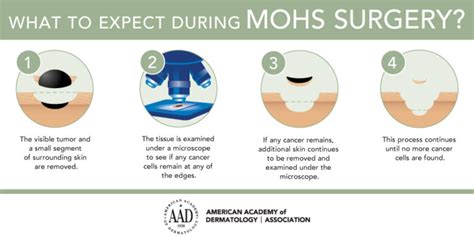 Mohs Surgeon Chicago Surgery And Closure