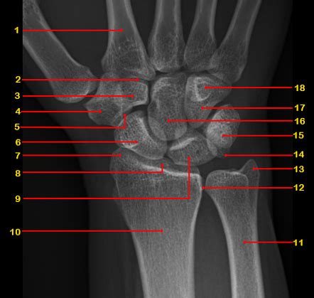 Wrist Radiology Reference Article Radiopaedia Org