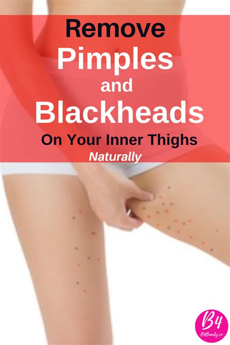 Pimples And Blackheads Inner Thighs Pictures And Get Rid Of Them Inner