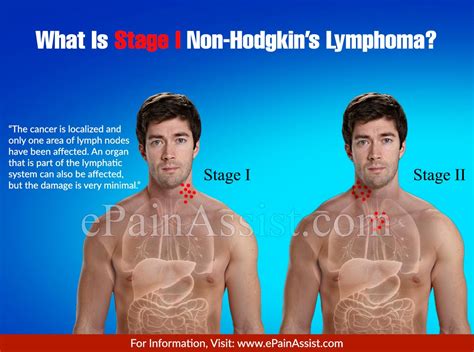 What Is Stage I Non Hodgkins Lymphoma