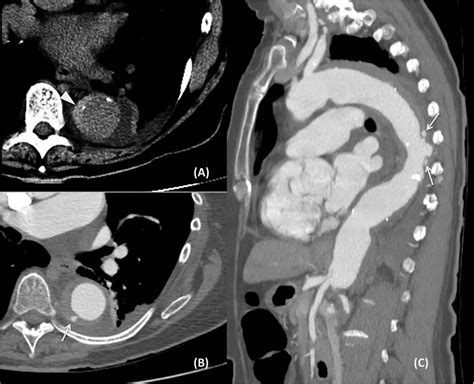 Aortic Intramural Hemorrhage Secondary To Penetrating Atherosclerotic