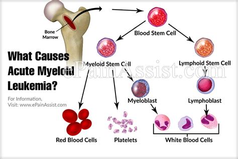 What Causes Acute Myeloid Leukemia And What Are Its Treatment Options