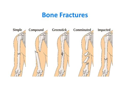 Bone Fractures Causes Symptoms And Treatment