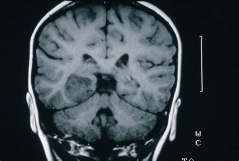 Mri Scan Brain Cancer Astrocytoma Wellcome Collection
