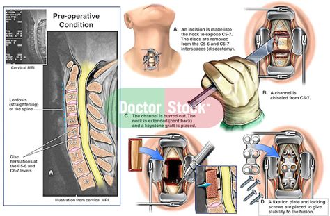 Cervical Spine Injuries With Proposed Spinal Fusion Surgery Doctor Stock