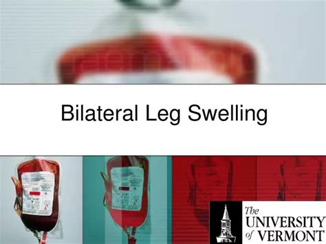 Ppt Bilateral Leg Swelling Powerpoint Presentation Free Download