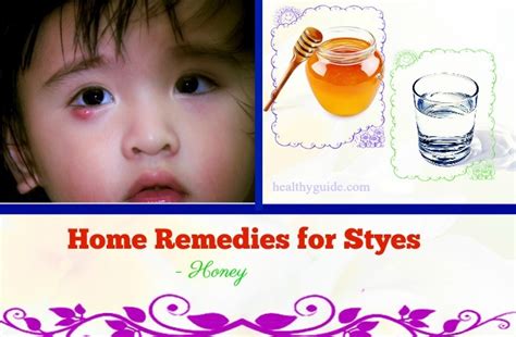 49 Home Remedies For Styes On Upper Lower Eyelid In Babies Toddlers