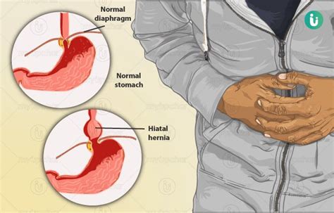 Hiatal Hernia Symptoms Causes Prevention Diagnosis Treatment Fundoplication Surgery