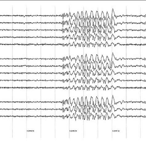 Interictal Eeg Of Patient Jl Sequential Pages Of The Eeg Showing