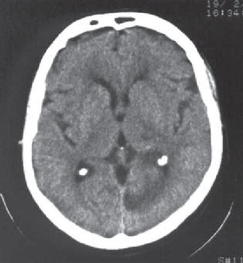 Massive Intracerebral Haemorrhage Of The Basal Ganglia With A And