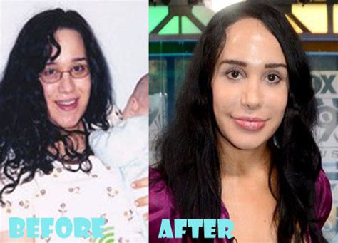 Nadya Suleman Plastic Surgery Before And After Lovely Surgery Celebrity Before And After Picture